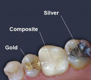 Types of tooth filling material